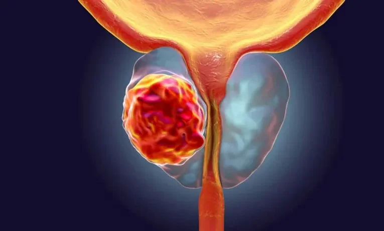 El cáncer de próstata tratado con crioablación no afecta el desempeño sexual ni causa incontinencia