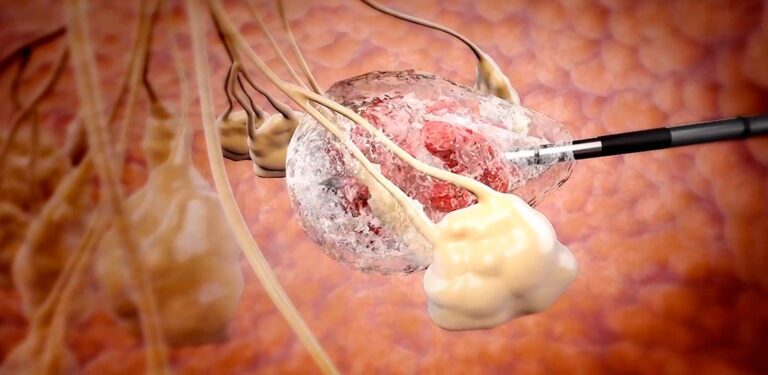 Foto cryo bola de hielo 1